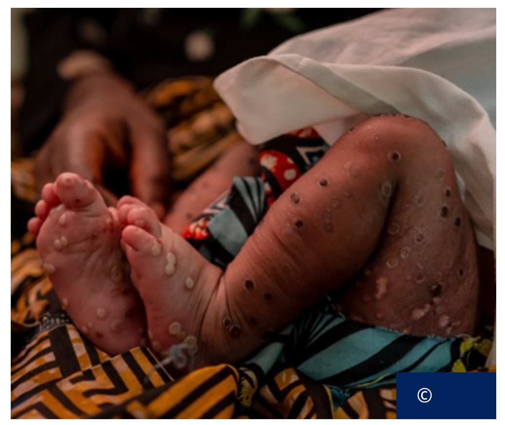 Africa CDC and WHO Launch Updated Continental Mpox Response Plan Amid Widening Outbreak. 